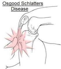 Osgood Schlatters Disease Exercises Knee Pain Explained