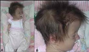 Aspecto extra-oral da paciente apresentando crânio em formato de torre,... 