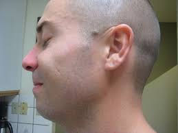 How To Remove Moles with Apple Cider Vinegar