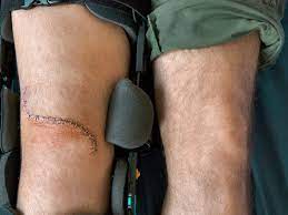 We did not find results for: What To Expect With An Artificial Knee