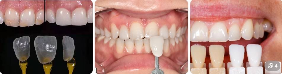 Veneers & Aesthetic Restorations product image