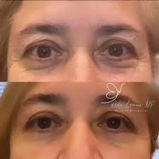 Pinch party ready for our dolls ❤️ ✨ ADD Microneedling to your  anti-wrinkle/ preventative care to enhance collagen production and improve  unwanted lines and wrinkles. It works for all skin types (young