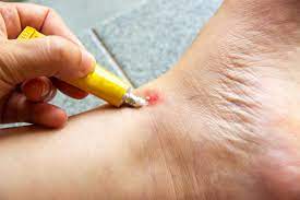 Check spelling or type a new query. Home Remedies For Mosquito Bites 6 Ways That Work