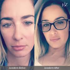 100 Off Juvederm For A Limited Time At Hz Plastic Surgery In Orlando If You Re Interested In Correcting Juvederm Before And After Plastic Surgery Lip Shapes