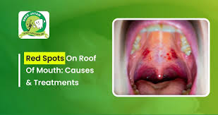 Image result for Erythroplakia roof of mouth