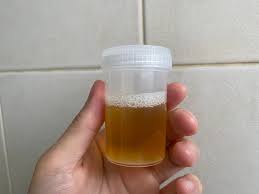 Image result for Isolated Proteinuria