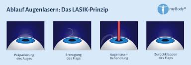 Das lasern der augen eignet sich zur korrektur von fehlsichtigkeit. Augenlaser Augen Lasern Statt Brille Oder Kontaktlinsen