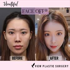 Face Off Plastic Surgery Facial Contouring Plastic Surgery Photos