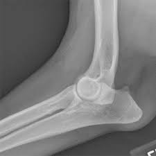 Image result for Elbow XRay