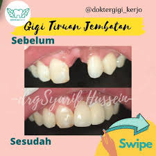 Maybe you would like to learn more about one of these? Gigi Tiruan Jembatan Gigi Praktek Dokter Gigi Kerjo Facebook