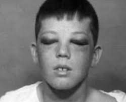 In den 1930er- und 40er-Jahren lebte Grace McDaniels mit einer schweren  Gesichtsmissbildung, verursacht durch das seltene Sturge-Weber-Syndrom.  Doch anstatt Mitgefühl zu erfahren, wurde sie in Wanderschauen unter einem  grausamen Spitznamen bekannt –