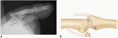 Image result for Lateral PIP Dislocation