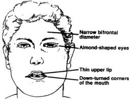 The Genetics Diagnosis And Management Of Prader Willi Syndrome Journal Of Pediatric Health Care