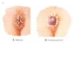La trombosis hemorroidal se origina cuando se forma un coágulo de sangre en esas venas inflamadas, llamado trombo. Caracteristicas De Los Diferentes Tipos De Hemorroides