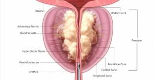 Bere almeno 1,0 ml di acqua ogni 1,0 kcal assunta con la dieta incrementare i cereali integrali e i legumi (questi ultimi, anche senza buccia ) Ingrossamento Prostata Un Trattamento Rivoluzionario Risolve Il Problema In 5 Minuti