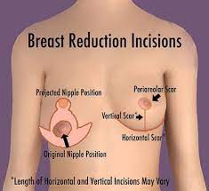 Id considered reduction mammoplasty, sure, but i really couldnt afford it. Breast Reduction Surgeons In Chennai Reviews Cost Success Rate Address And Online Appointment Medcontour