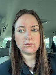 Question for the ladies. I use bum cream (hemorrhoid cream) for the severe  pain. I have crohns colitis. The cream leaks forward and causes vaginal  problems. I try to put a small