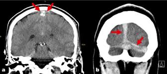 Anatomic variability of the cerebral venous system makes ct diagnosis of cvt insensitive, results on no contrast head ct. Oa Text Is An Independent Open Access Scientific Publisher Showcases Innovative Research And Ideas Aimed At Improving Health By Linking Research And Practice To The Benefit Of Society