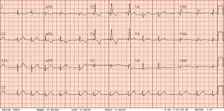 Image result for Cardiac Contusion