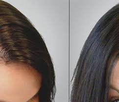 اسعار زراعة الشعر فى مصر hair styles hair long hair styles