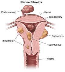 Uterine Fibroids Treatment Option Hysteroscopic Myomectomy
