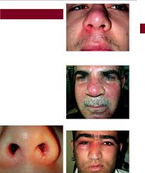 Minor infections at the opening of the nose may result in pimples at the base of nasal hairs (folliculitis) and sometimes crusts around the nostrils. Diagnosis In Otorhinolaryngology Onerci 2009 Str 8