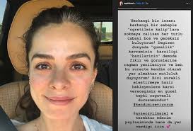 Makyajsız hali ve şiş yüzü ile görüntülenen 36 yaşındaki emina jahovic, kendisine yöneltilen soruları cevapsız bıraktı. Hadise Nin Makyajsiz Hali Yeni Bir Akim Mi Baslatiyor Sadece Haber