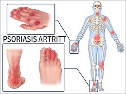 Medisinering, fysioterapi og kirurgi er påvist behandlinger for ra. Psoriasis Artritt Inflammatorisk Leddsykdom