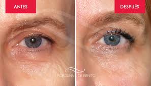 Las arrugas son parte del proceso de envejecimiento. Parpados Y Ojeras Rellenos Porcuna De Benito