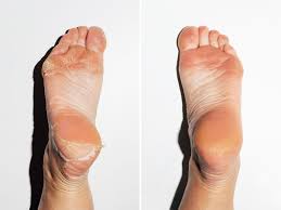 Do not do it when it's wet as your skin will be all spongey and soft and you may. Baby Foot Peel Review Is It Safe And Does It Really Work The Skincare Edit