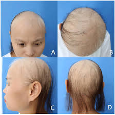 Image result for HAIR Score