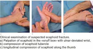 Image result for Scaphoid Fracture Signs