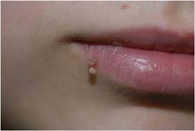 Image result for verrucae filiformes