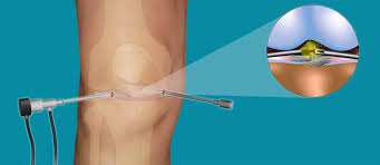 What is the recovery time for a dislocated knee? Arthroscopic Knee Surgery