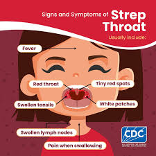 Image result for Strep throat infection roof of mouth