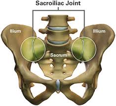Image result for Sacroiliac Dysfunction