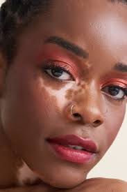 Image result for Vitiligo