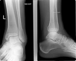 Learn vocabulary, terms and more with flashcards, games and fracture is a spiral fracture of the proximal third of the fibula associated with a tear of the distal. The Ankle