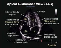 Apical 4 Chamber View Tee Diagnostic Medical Sonography Medical Ultrasound Cardiac Sonography