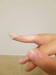 You'll receive email and feed alerts when new items arrive. Splinted Learning To Cope With Mallet Finger The Pathless Wood