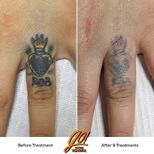 Once the laser breaks up the ink molecules in your tattoo, the lymphatic. à¦Ÿ à¦‡à¦Ÿ à¦° Go Tattoo Removal This Is A Blackout Cover Up And Now It S All Gotta Go Finger Tattoos Tend To Be Stubborn Throw In All The Ink And We Knew This One