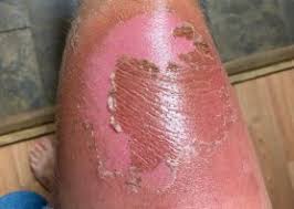 Image result for Photodermatitis