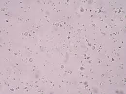 Des formes plus complexes sont possibles (haltères). Cristal D Oxalate De Calcium En Urine Image Stock Image Du Vieux Colorant 67142453