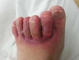 Image result for diabetic toes