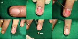 Image result for Glomus tumor