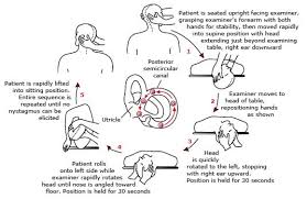 Image result for Canalith Repositioning Procedure