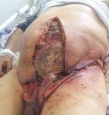 The primary symptom of fournier disease is severe pain and redness in the scrotum. File Fournier S Gangrene 1 Jpg Wikimedia Commons