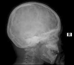 Copper beaten skull is the term used for a finding where it is not smooth but has inner markings, which correspond to the form of the brain gyri, the there is also a percentage of cases where it is seen in completely normal patients, so it could be nothing to worry about, perhaps if you said something more. Copper Beaten Skull Radiology Reference Article Radiopaedia Org