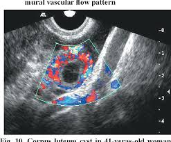 Image result for corpus luteum sonography)