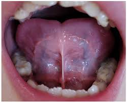 Image result for Ankyloglossia